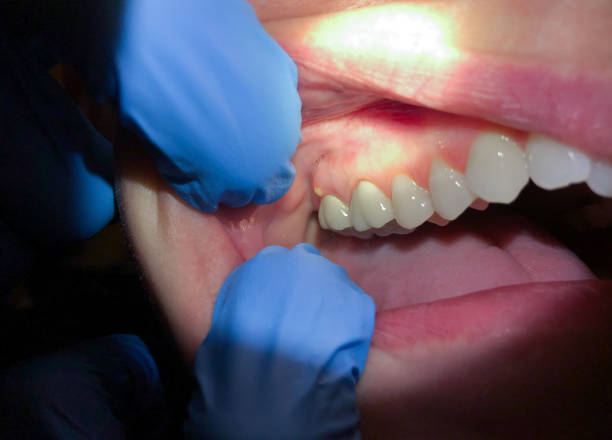Best Urgent Care for Lost Fillings or Crowns in Montour Falls, NY